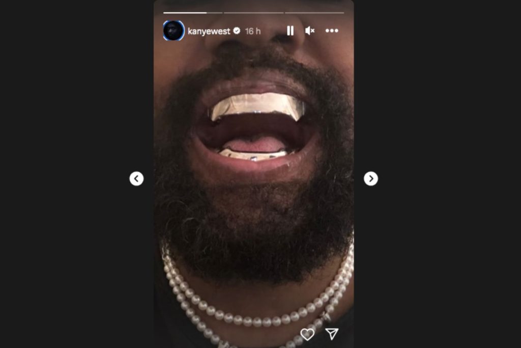 Kanye West si fa rimuovere i denti e si fa applicare delle protesi dentali in titanio, come il cattivo di JAmes Bond, Jaws.