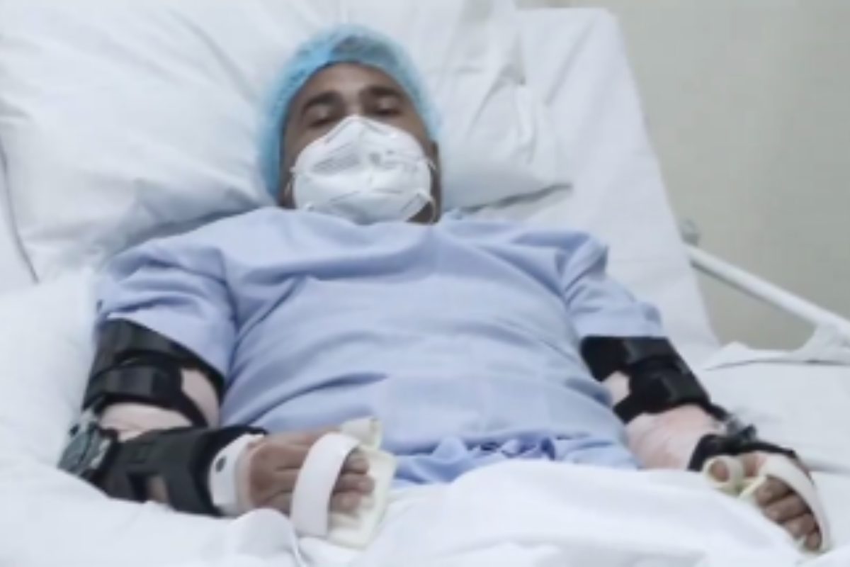 Uomo sottoposto a un trapianto di mano in India.