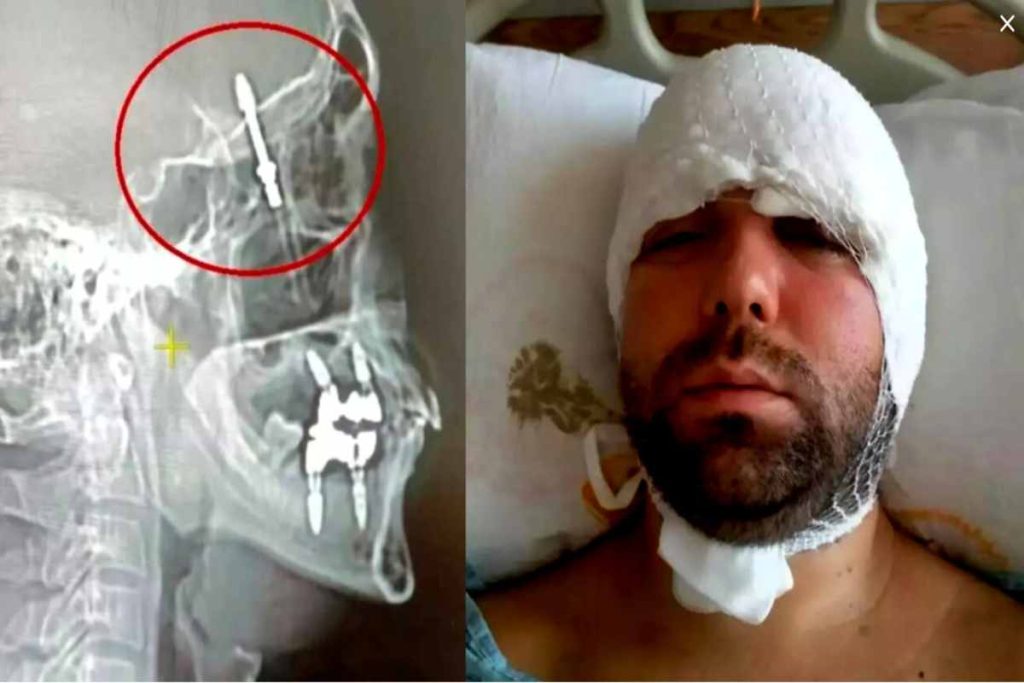 vite nel cranio incidente